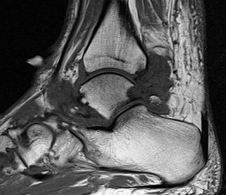 Figure 4 for case Gout arthritis ( RID3567 )